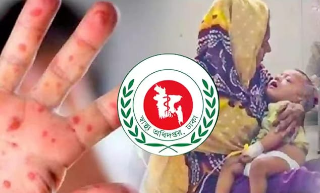 দেশে বাড়ছে হাম: ২৪ ঘণ্টায় আরও ৫ শিশুর মৃত্যু, নতুন আক্রান্ত ১,২৭৮